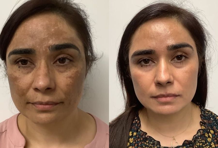 Before / After